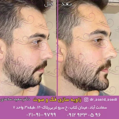 کانتورینگ دائمی صورت چیست؟