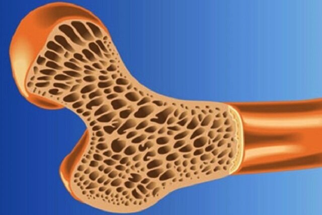 نقش تغذیه در پیشگیری از پوکی استخوان