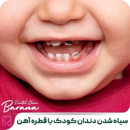 علت های سیاه شدن دندان کودکان