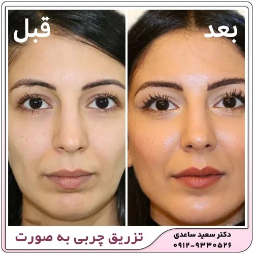 عوارض تزریق چربی به صورت