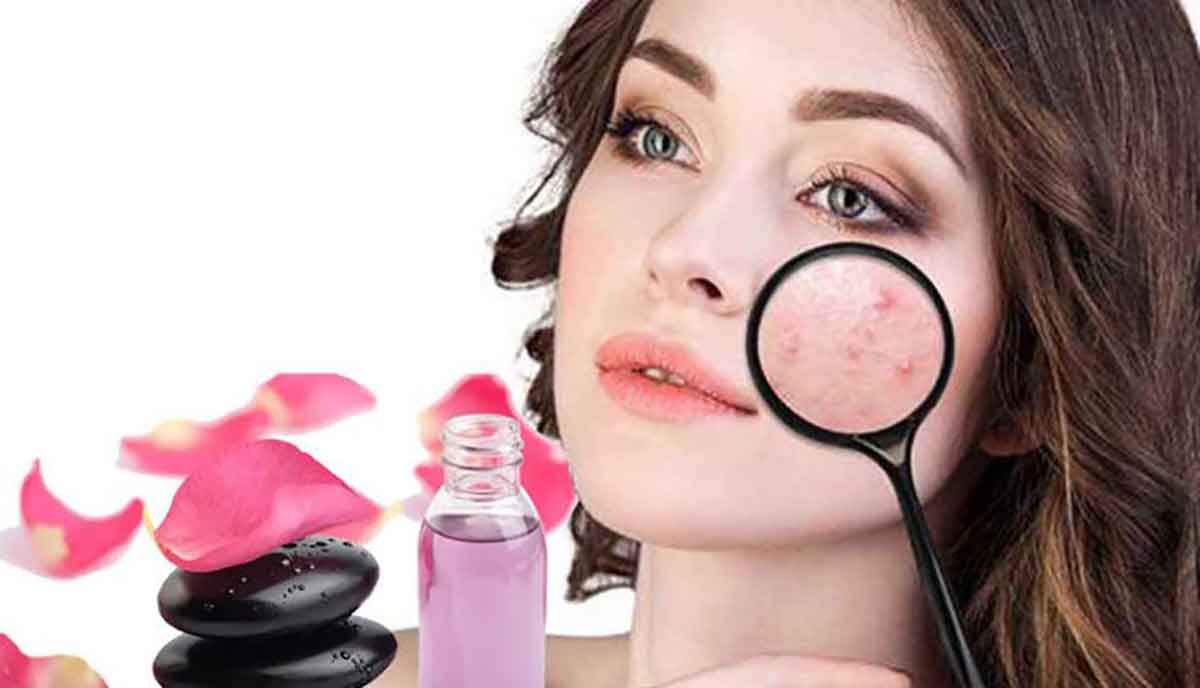 پوست درمان جوش صورت با طب سنتی؛ خداحافظی با جوش و آکنه