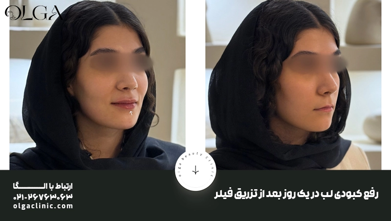 رفع کبودی لب بعد از تزریق ژل در یک روز
