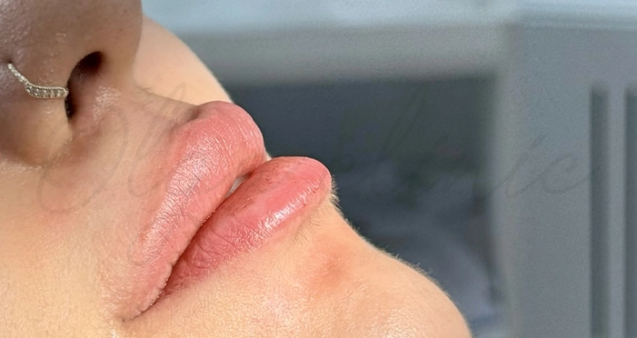 رفع کبودی لب بعد از تزریق ژل در یک روز